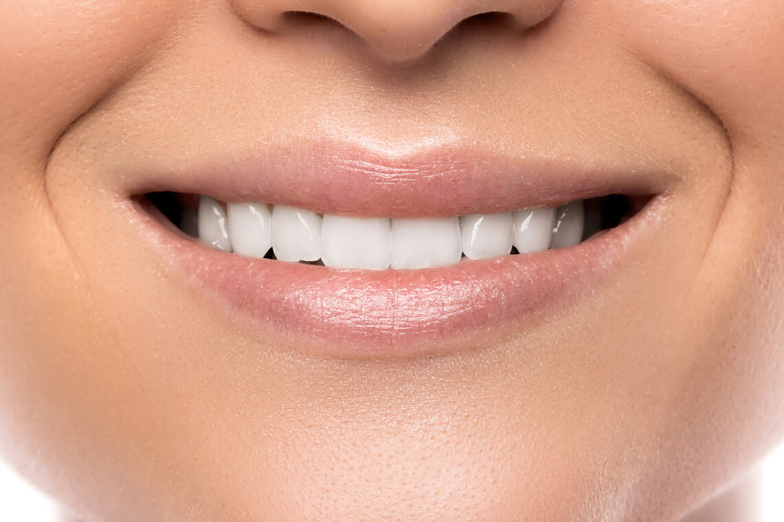 smiling-woman-with-a-bad-tooth-after 2