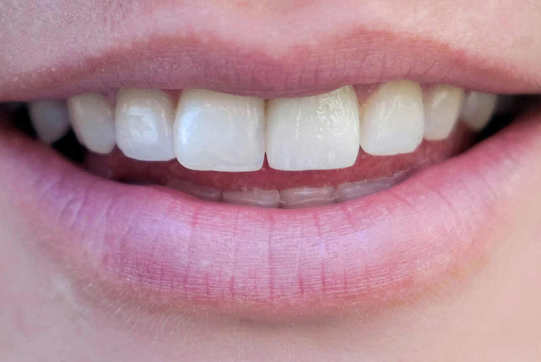 smiling-woman-with-a-bad-tooth-after