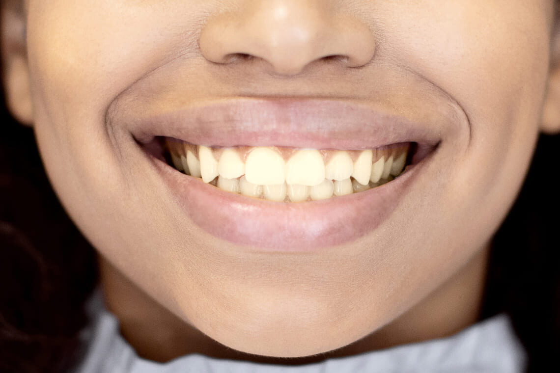 smiling-woman-with-a-bad-tooth-before 1
