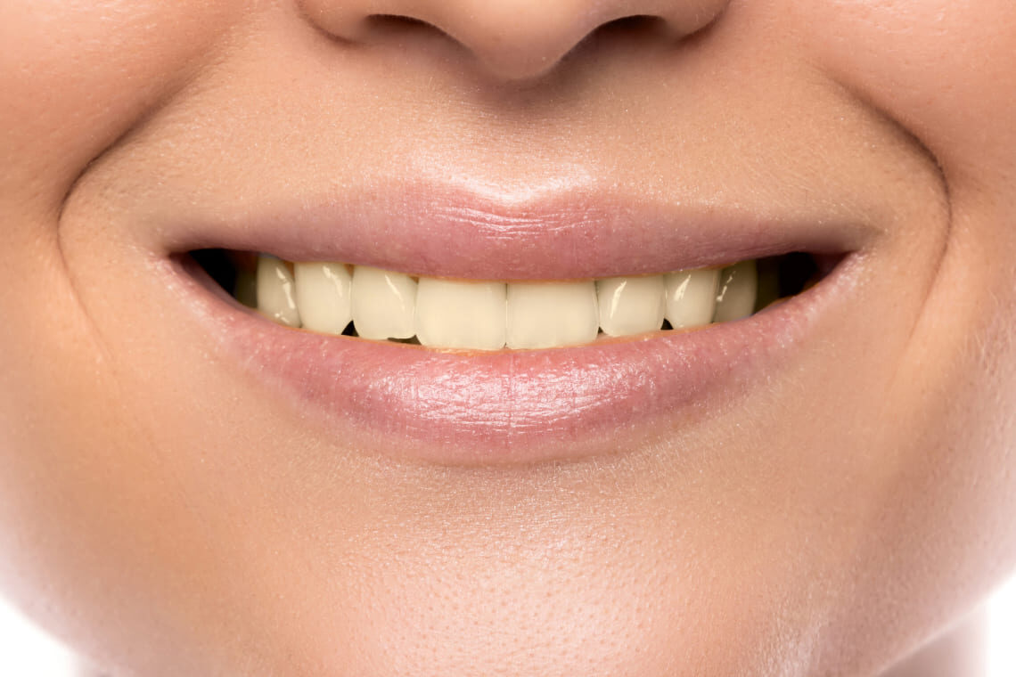 smiling-woman-with-a-bad-tooth-before 2