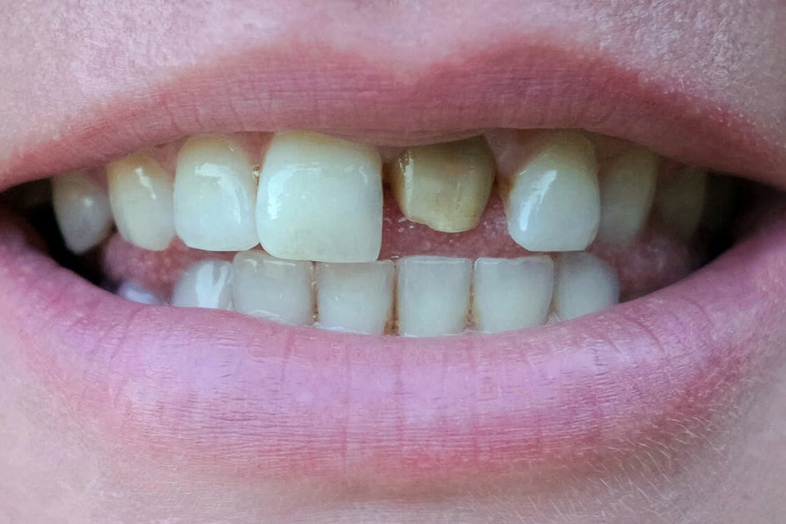 smiling-woman-with-a-bad-tooth-before