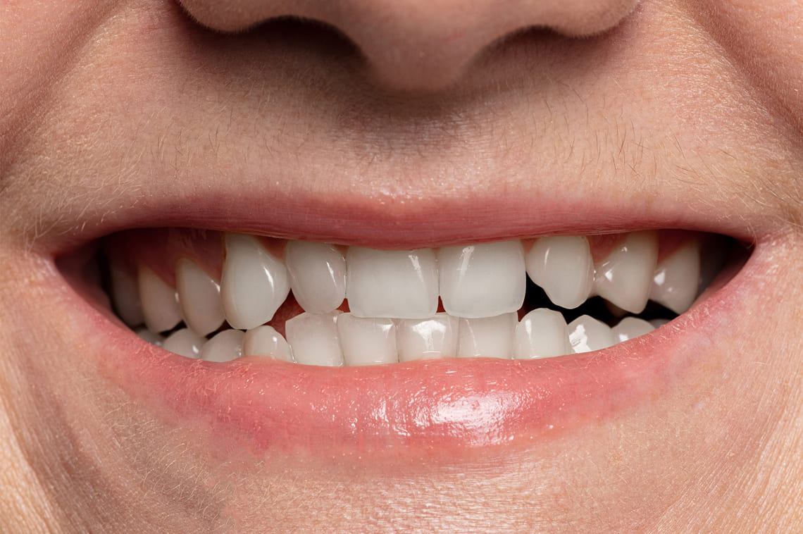 teeth-whitening-after-close-up